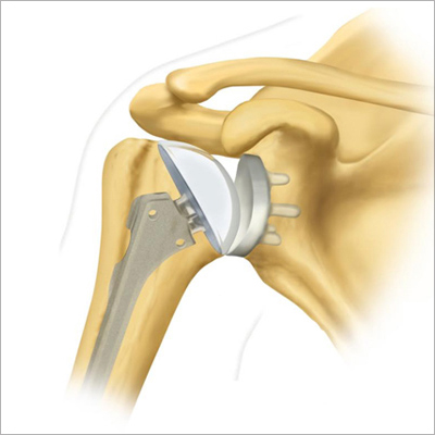 Shoulder joint prothesis