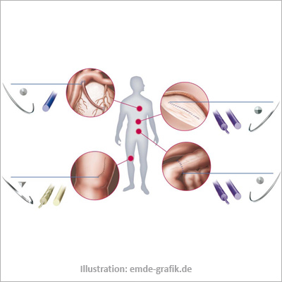 Usage of medical suture material